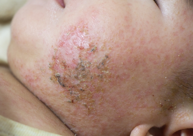 辛いかゆみや湿疹…アトピー性皮膚炎について知ろう！～アトピー性皮膚炎とは？編～