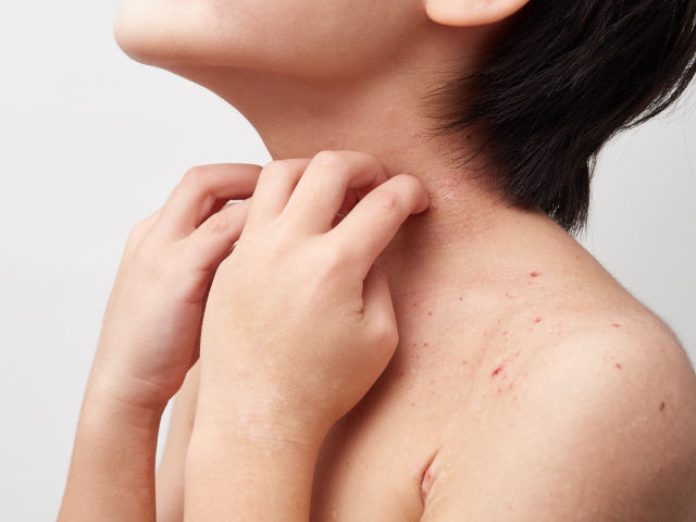 辛いかゆみや湿疹…アトピー性皮膚炎について知ろう！～アトピーの薬「ステロイド」編～