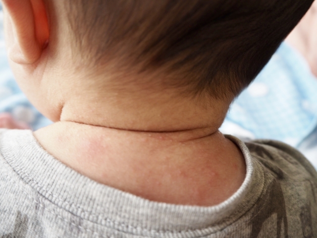 辛いかゆみや湿疹…アトピー性皮膚炎について知ろう！～赤ちゃんのアトピー原因と対処法編～